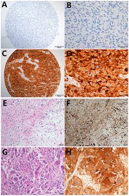 LGALS3 Is a Poor Prognostic Factor in Diffusely Infiltrating Gliomas and Is Closely Correlated With CD163+ Tumor-Associated Macrophages